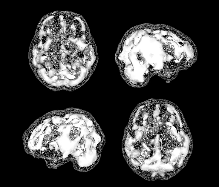 Active SPECT scan showing greater activity near the brain's surface, mostly along the sides and rear.