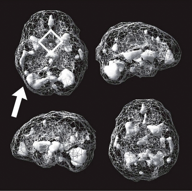 Active SPECT scan showing greater activity in scattered areas. Four areas are arranged in a diamond toward the front of the brain.