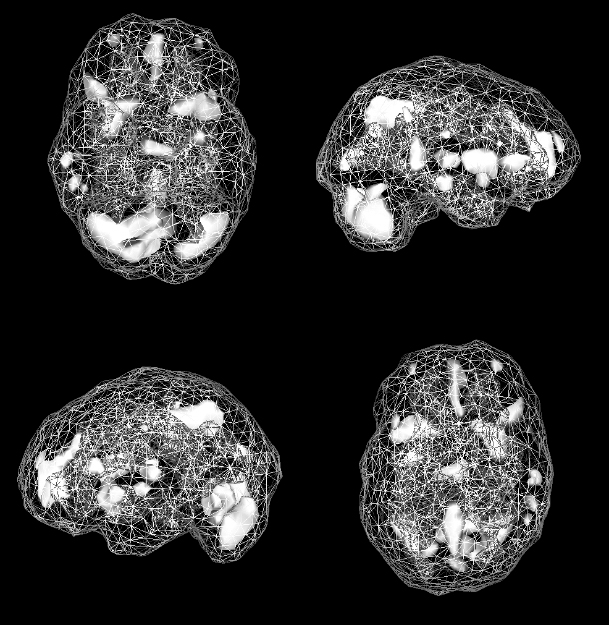 Active SPECT scan showing greater activity in scattered areas. Four areas are arranged in a diamond toward the front of the brain.