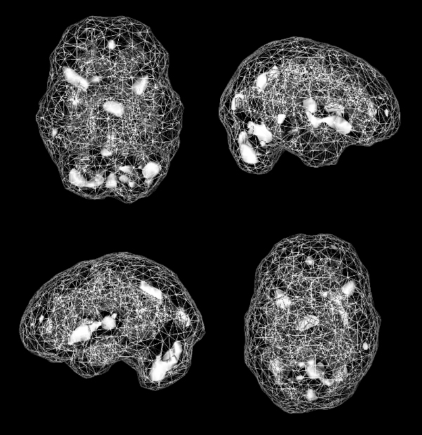 Active SPECT scan showing greater activity in scattered areas, but the areas of greatest activity are smaller.