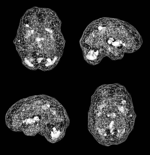 Active SPECT scan showing greater activity in the cerebellum.