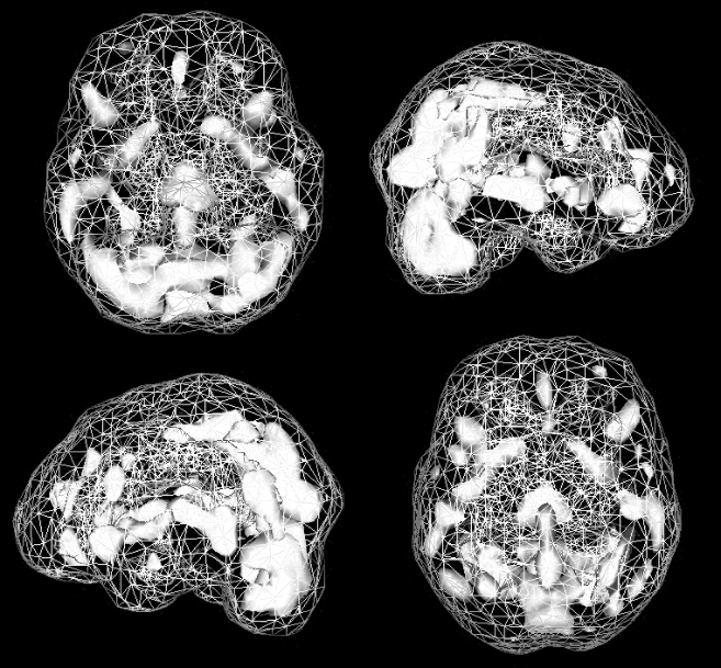 Active SPECT scan showing large regions of activity in scattered areas.