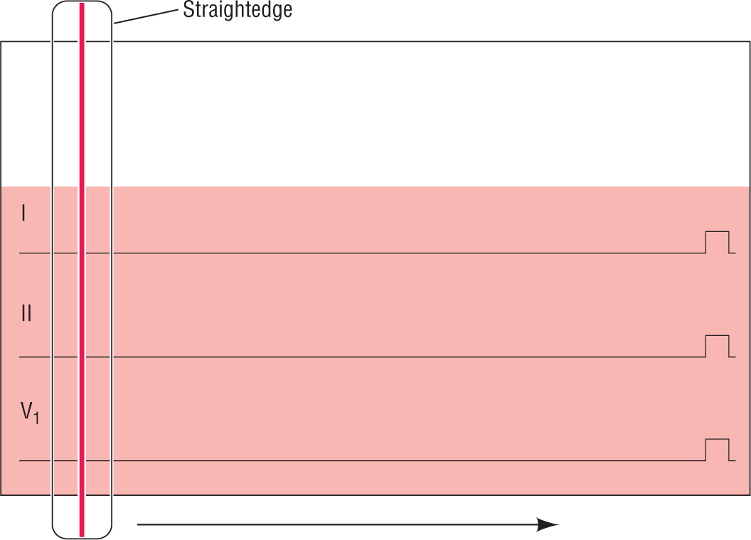 An illustration shows a transparent straightedge with a red line placed over an ECG paper marked for three leads, 1, 2, and V1.