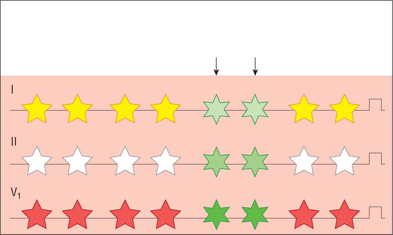 An illustration shows an ECG paper marked for three leads, 1, 2, and V1. Each lead has eight stars. Stars 5 and 6 are six-pointed, while the rest are five-pointed.