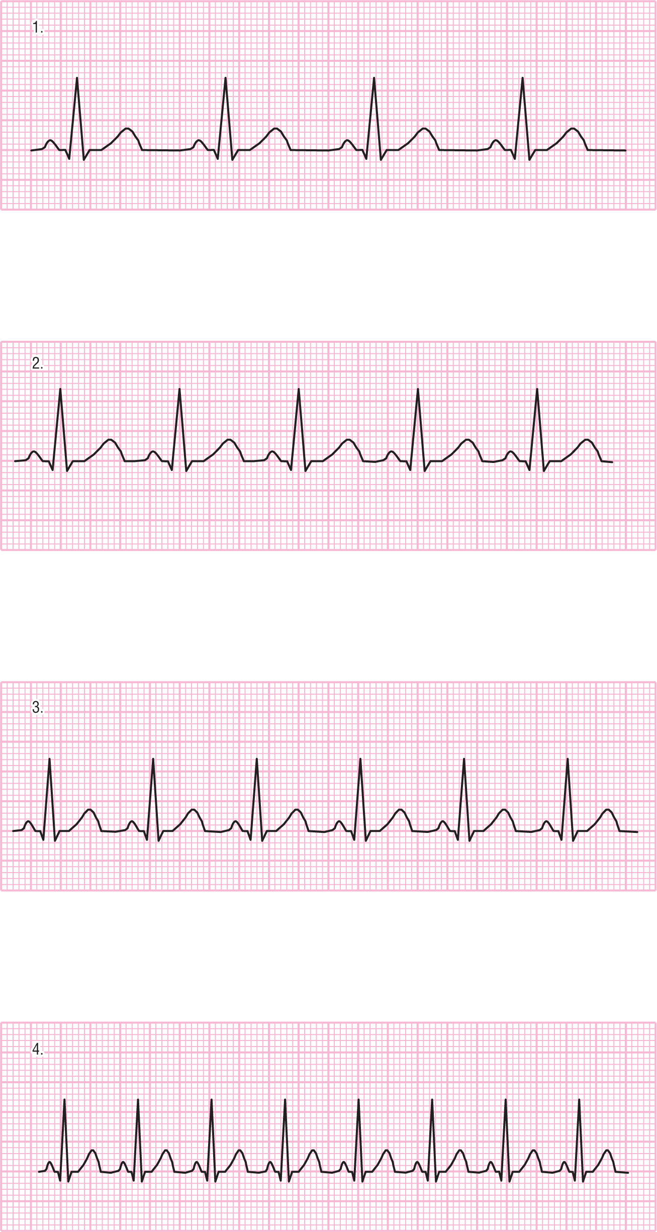 A rhythm strip.