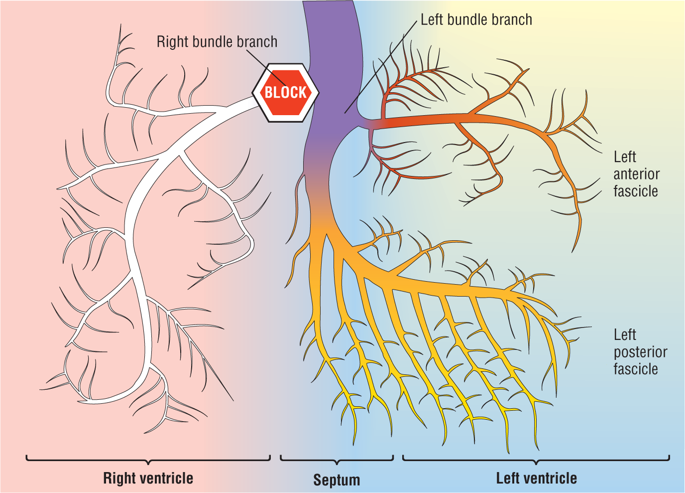 An illustration shows a block in the origin of the right bundle branch.