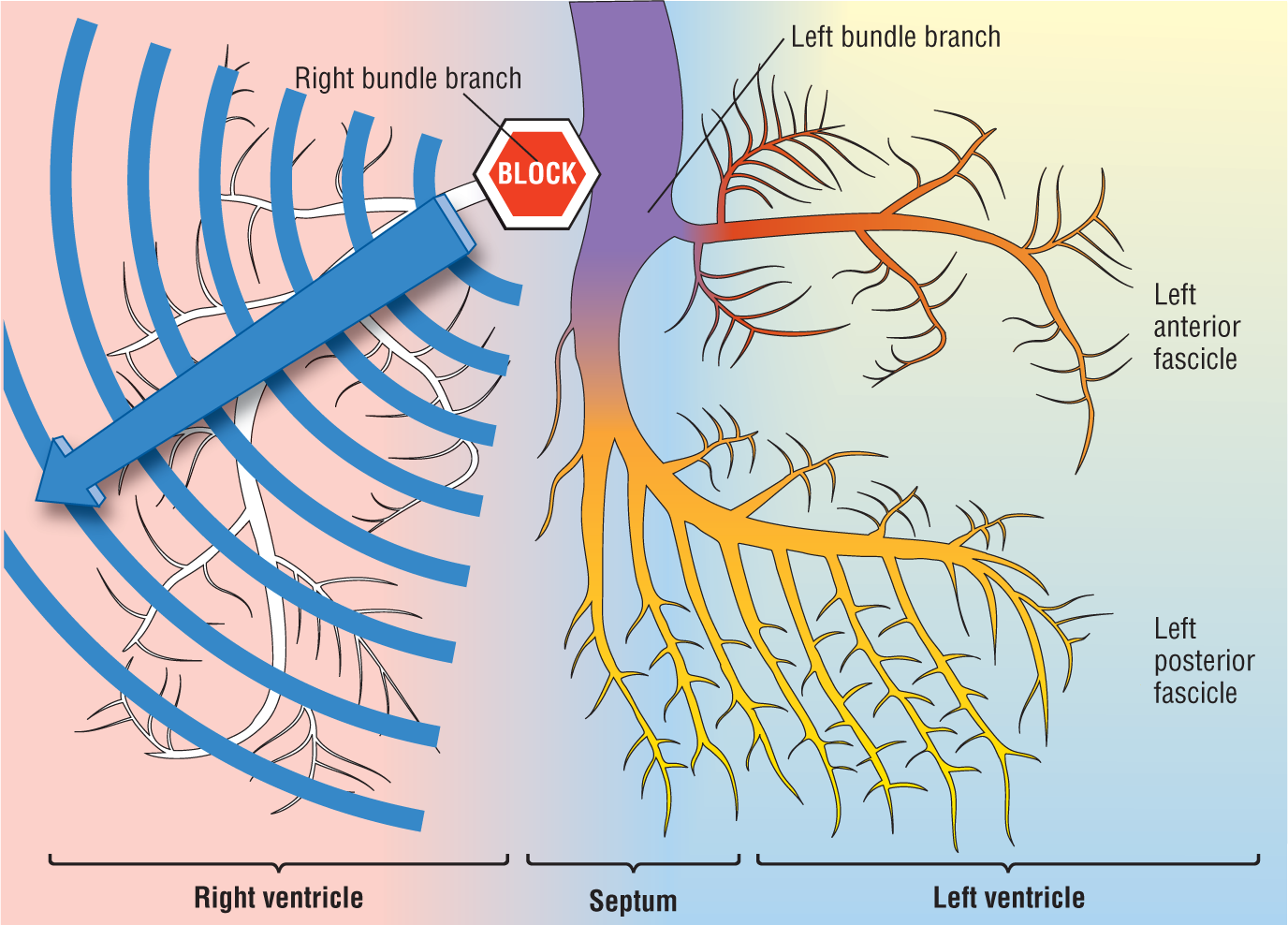 An illustration shows a pulse radiating from a block in the origin of the right bundle branch.