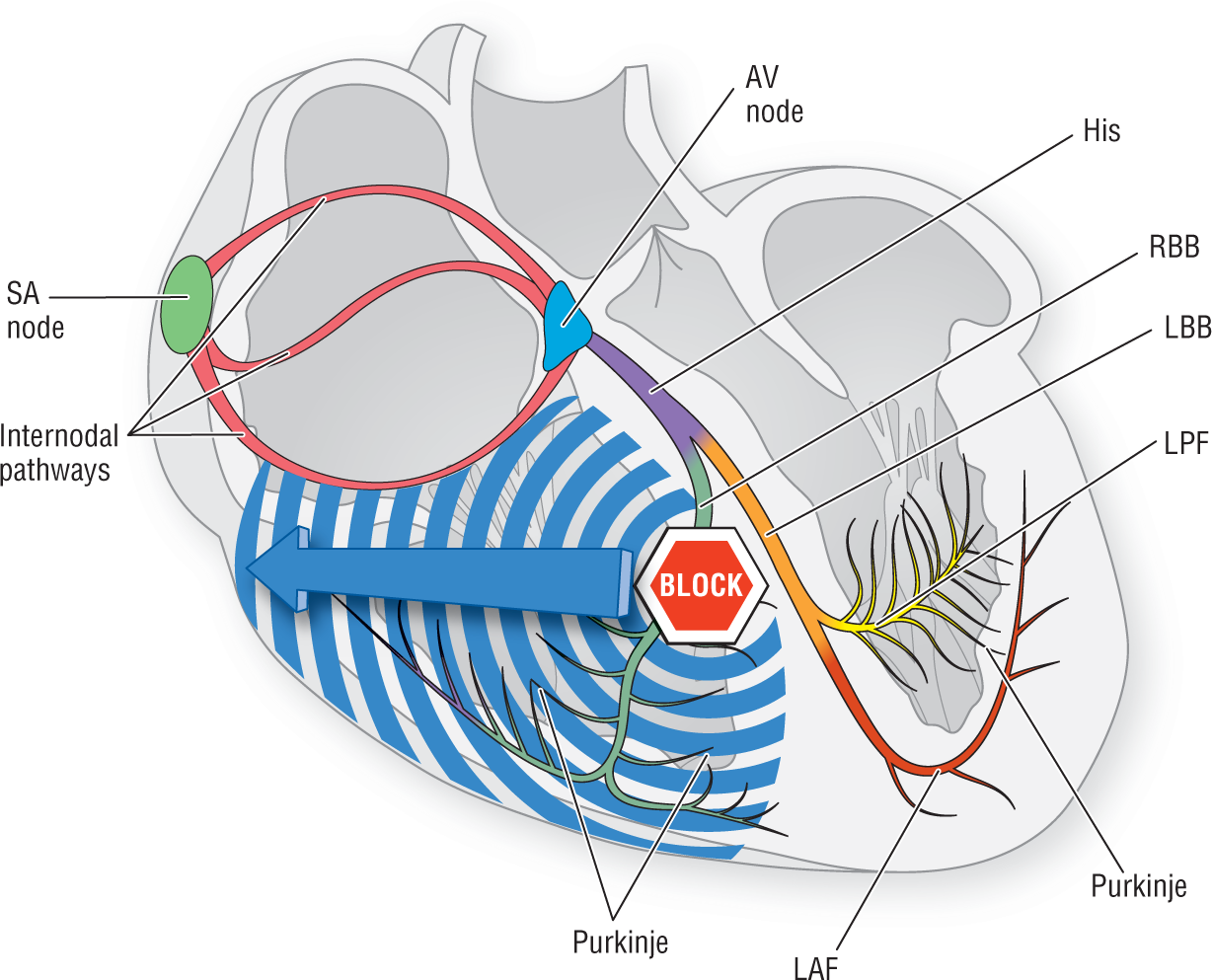 An illustration shows the electrical conduction system of the heart. A block in the RBB sends a pulse into the right ventricle.