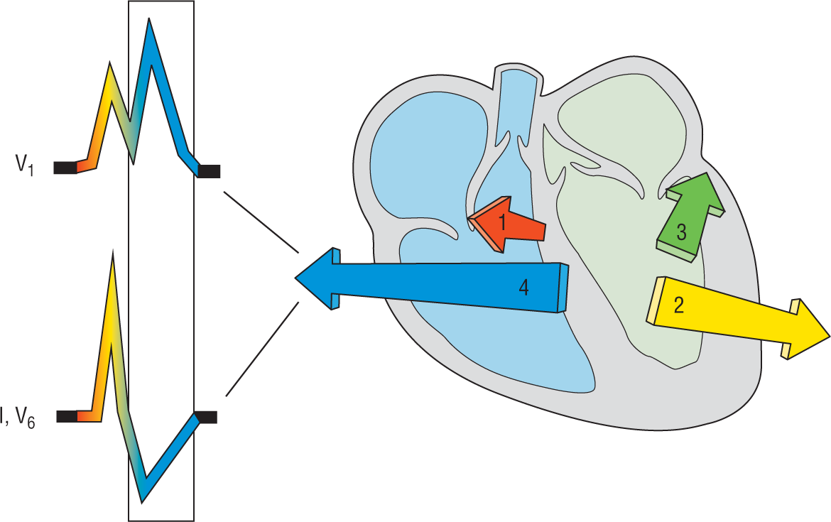 An illustration shows the effects of the pulse in the right bundle branch block on the ECG leads.