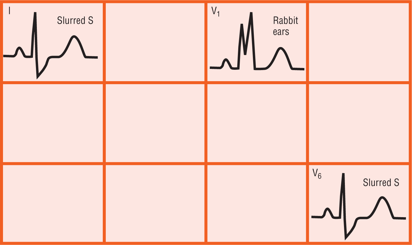 An illustration shows that in an ECG, slurred S waves occur in leads 1 and V6, while rabbit ears waveform occurs in lead V1.