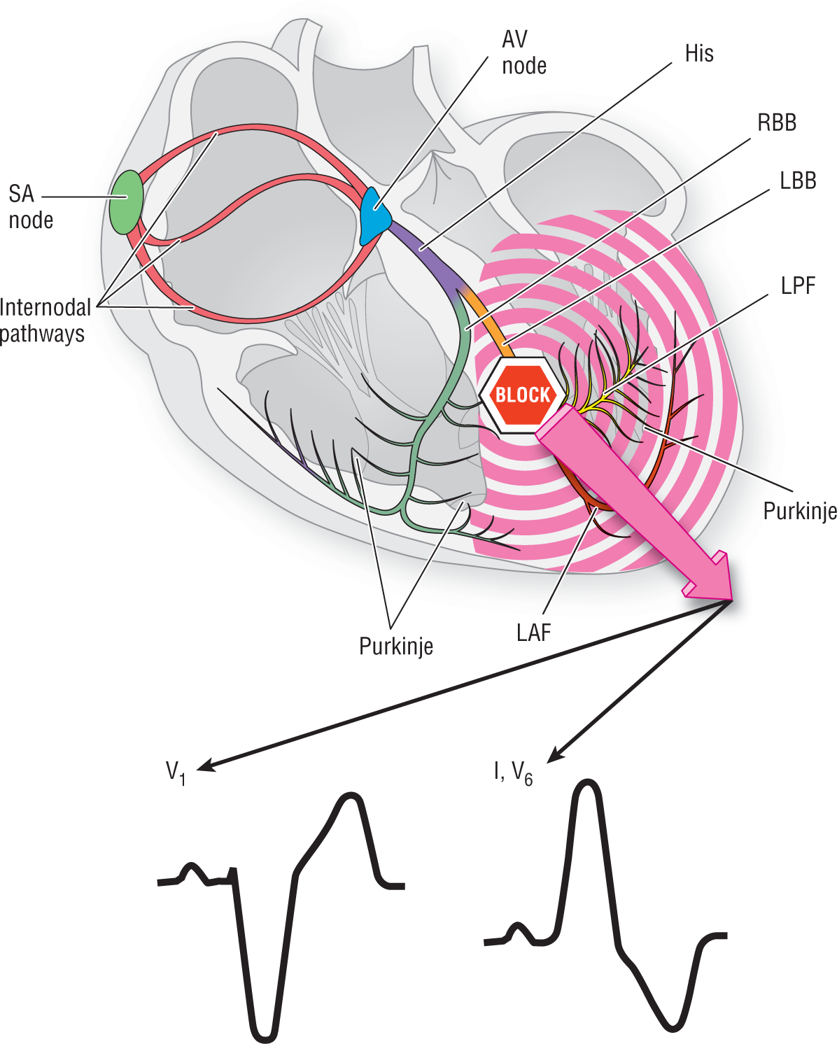 An illustration shows the waveforms during left bundle block.