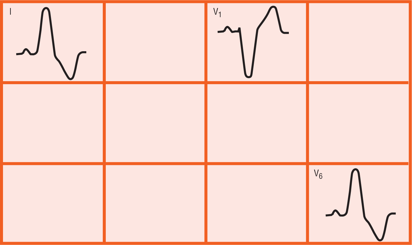 An illustration shows the waveforms occurring in different regions of an ECG.