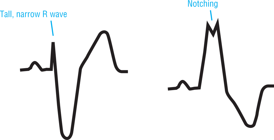 An illustration shows that some of the variations from the norm are having a tall, narrow R wave and notching of the R wave.