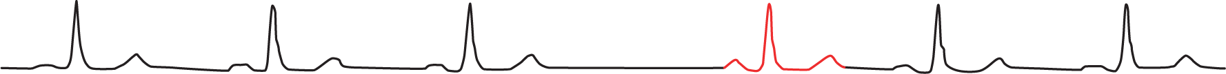 An illustration of a normal ECG waveform shows the fourth complex occurring after a delay.