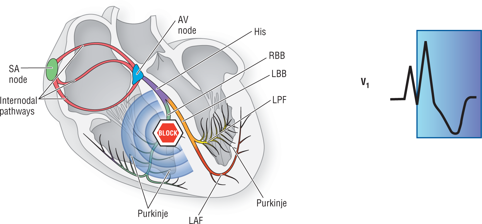 An illustration shows that when there is a block in the right bundle branch, the waveform at V1 shows a short peak, a tall peak, and a curved dip.