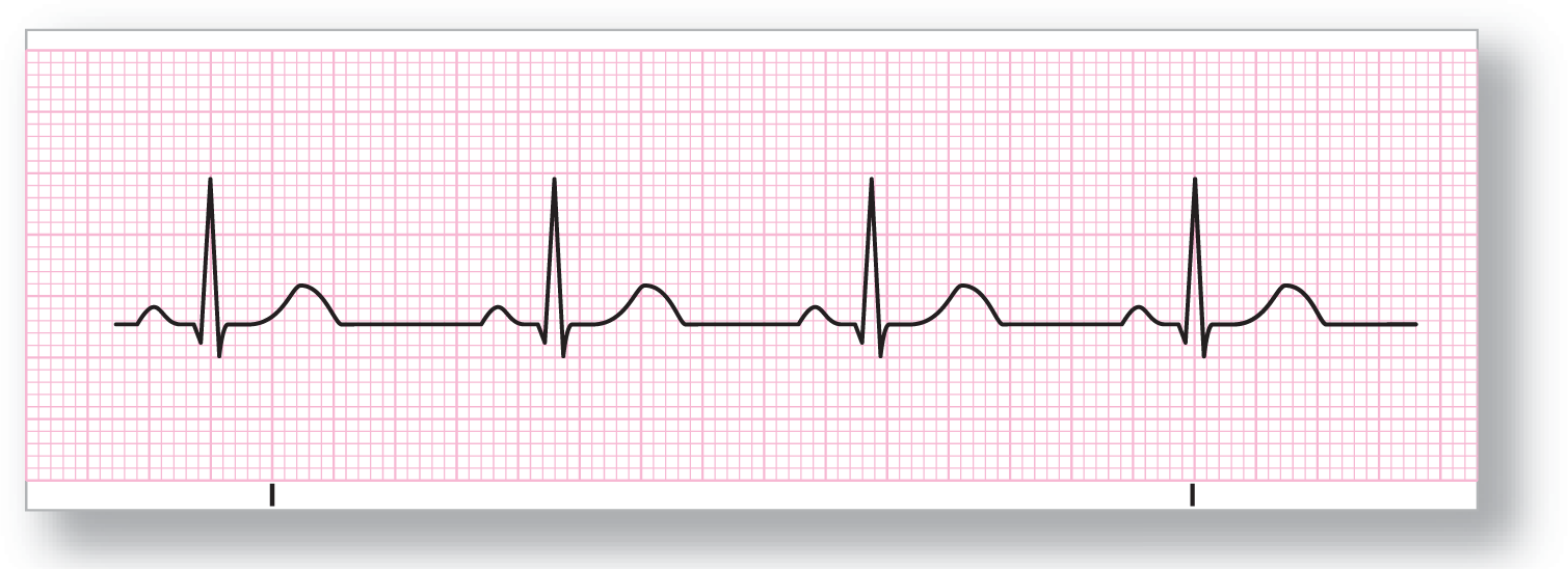 A rhythm strip for sinus bradycardia shows a rhythm with normal complexes occurring at longer intervals due to longer TP intervals.