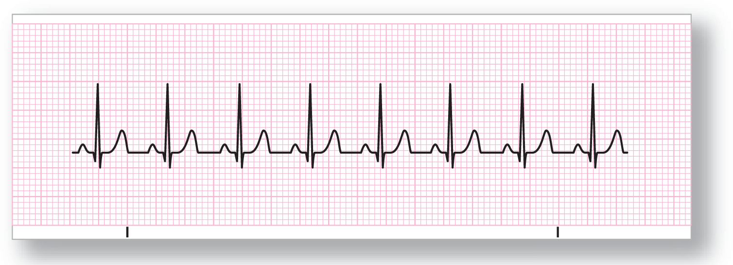 A rhythm strip for sinus tachycardia shows a rhythm with narrow complexes occurring at short intervals.