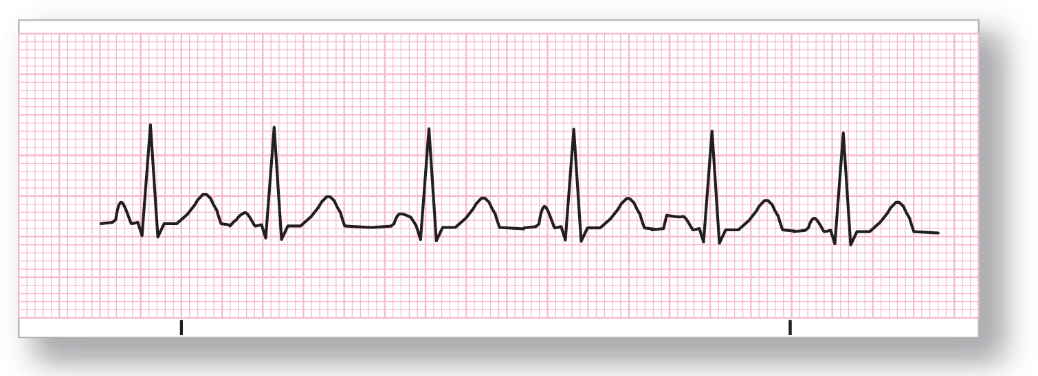 A rhythm strip for wandering atrial pacemaker shows a rhythm with normal frequency, variable PR and TP intervals, and varying morphology of P waves.