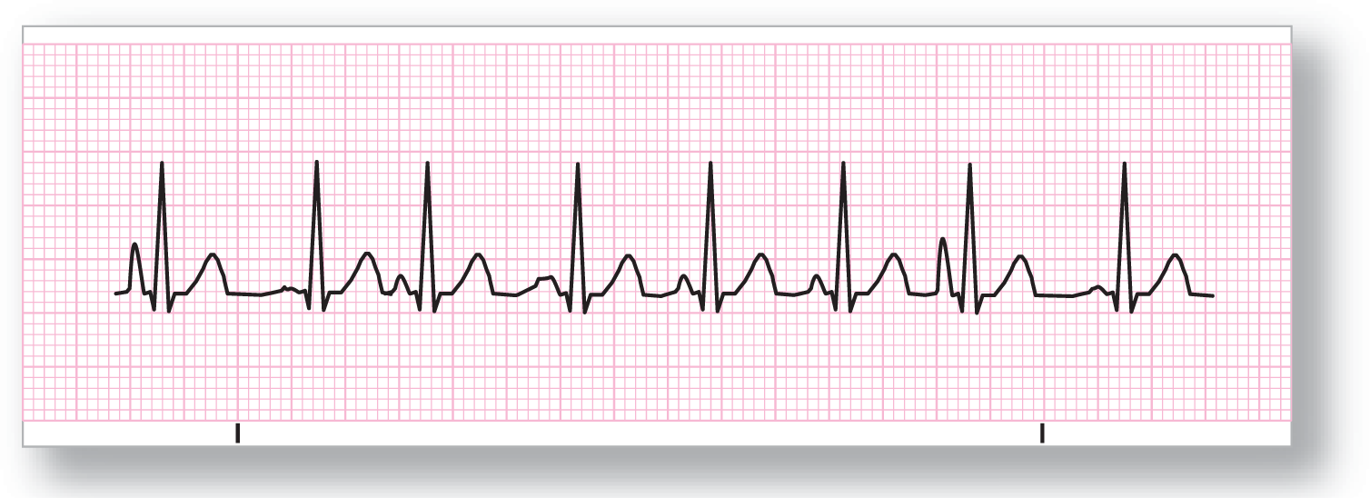 A rhythm strip for multifocal atrial tachycardia shows a rhythm with high frequency, variable PR and TP intervals, and varying morphology of P waves.