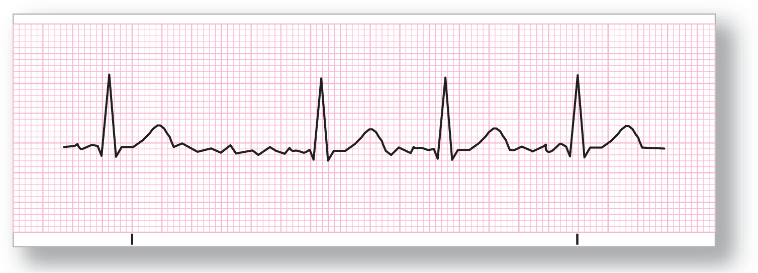 A rhythm strip for atrial fibrillation shows a rhythm with normal rate, and normal QRS complex and T waves, with irregular fluctuations between each complex.