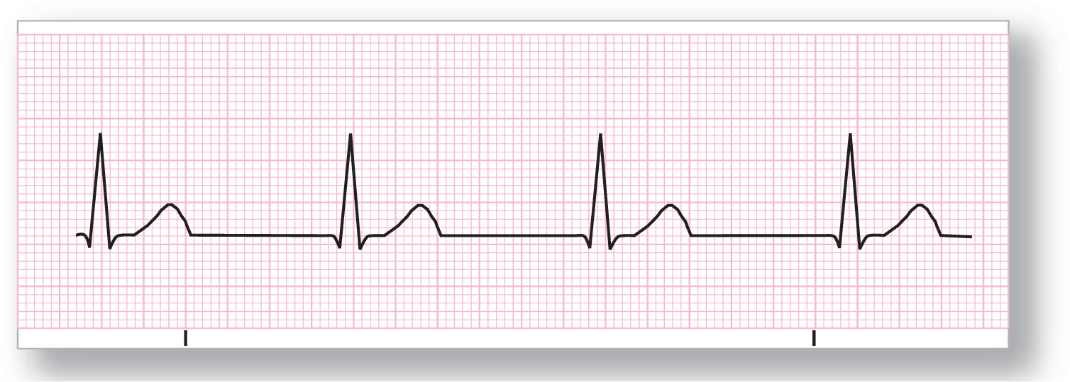 A rhythm strip for junctional rhythm shows a rhythm with normal rate and missing P waves.