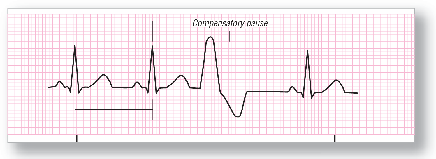 A rhythm strip for premature ventricular contraction shows a compensatory pause between two QRS complexes. The pause includes one beat. A complex with curved peak and curved dip is in the pause.