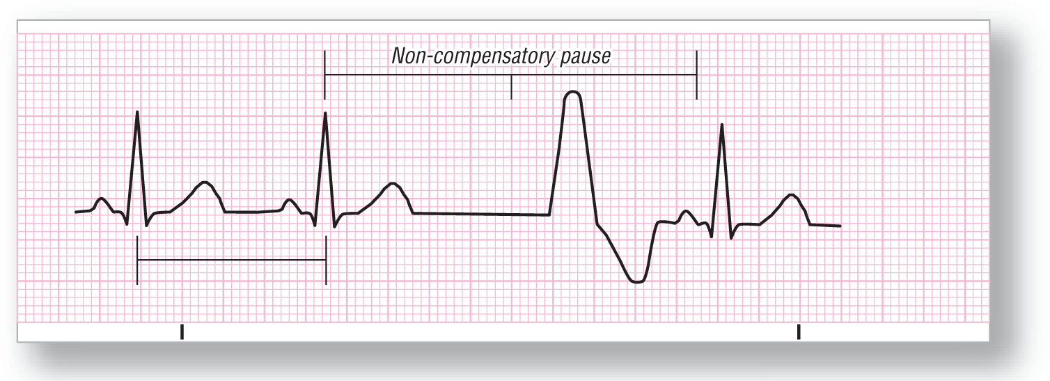 A rhythm strip illustrates ventricular escape beat.