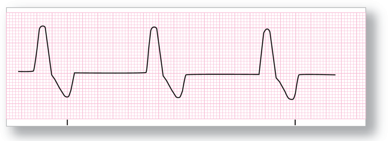 A rhythm strip for idioventricular rhythm shows a rhythm consisting of curved peak followed by curved dip occurring at normal rate and regular intervals.