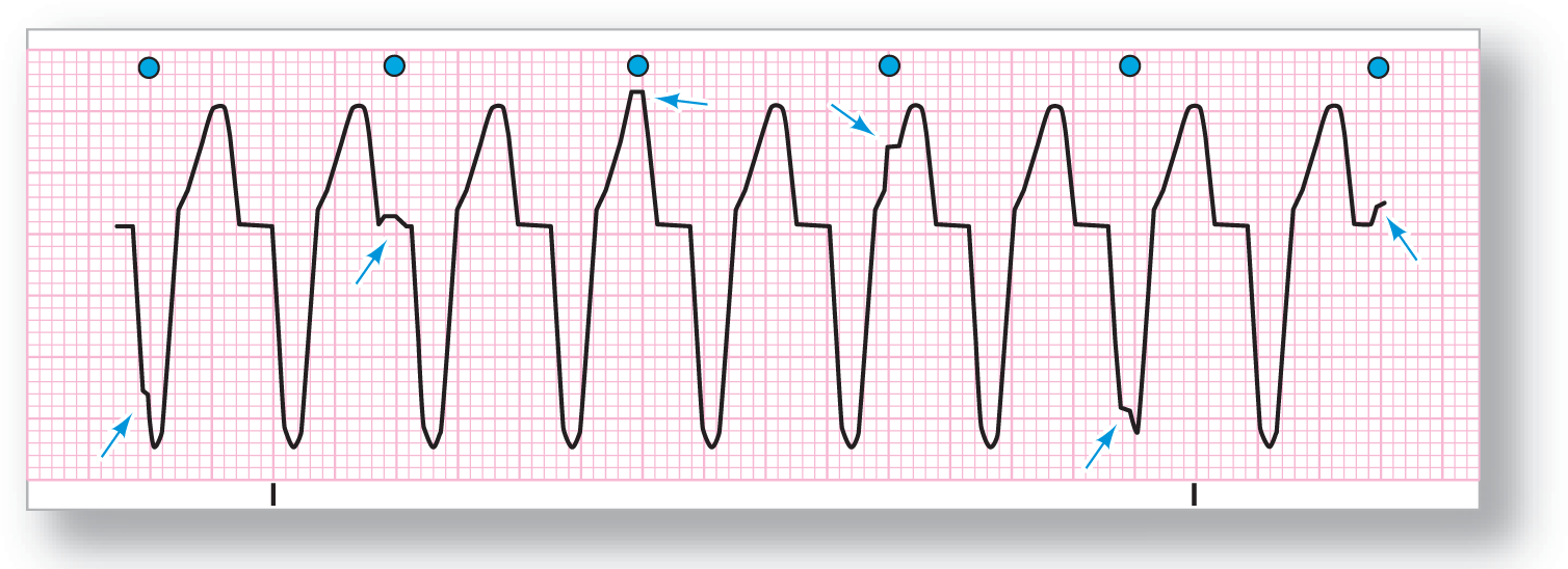 A rhythm strip illustrates ventricular tachycardia.