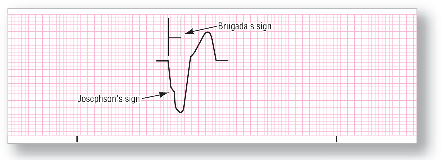 A rhythm strip illustrates Brugada’s and Josephon’s sign in the rhythm for ventricular tachycardia.