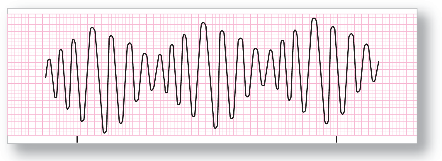 A rhythm strip for torsade de pointe shows a rhythm consisting of undulating sinusoidal waves, with each wave consisting of regular fluctuations at constant.