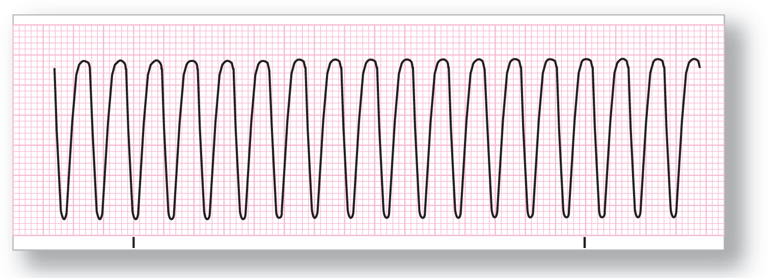 A rhythm strip for ventricular flutter shows a rhythm consisting of fluctuations with curved peaks, and high frequency, amplitude, and regularity.