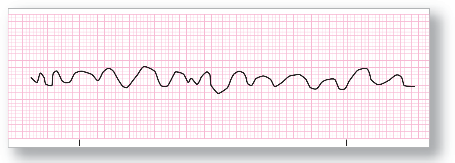 A rhythm strip for ventricular fibrillation shows a rhythm consisting of irregular fluctuations.