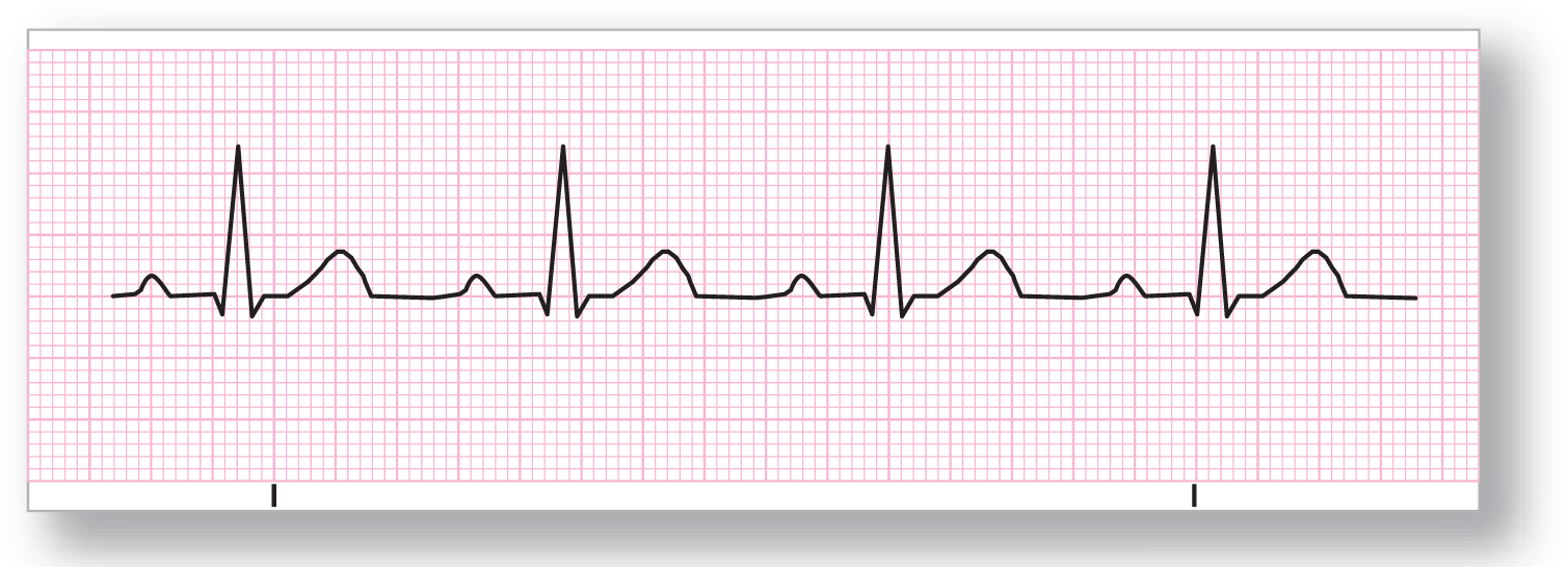 A rhythm strip for first-degree block shows a normal rhythm with prolonged PR interval.