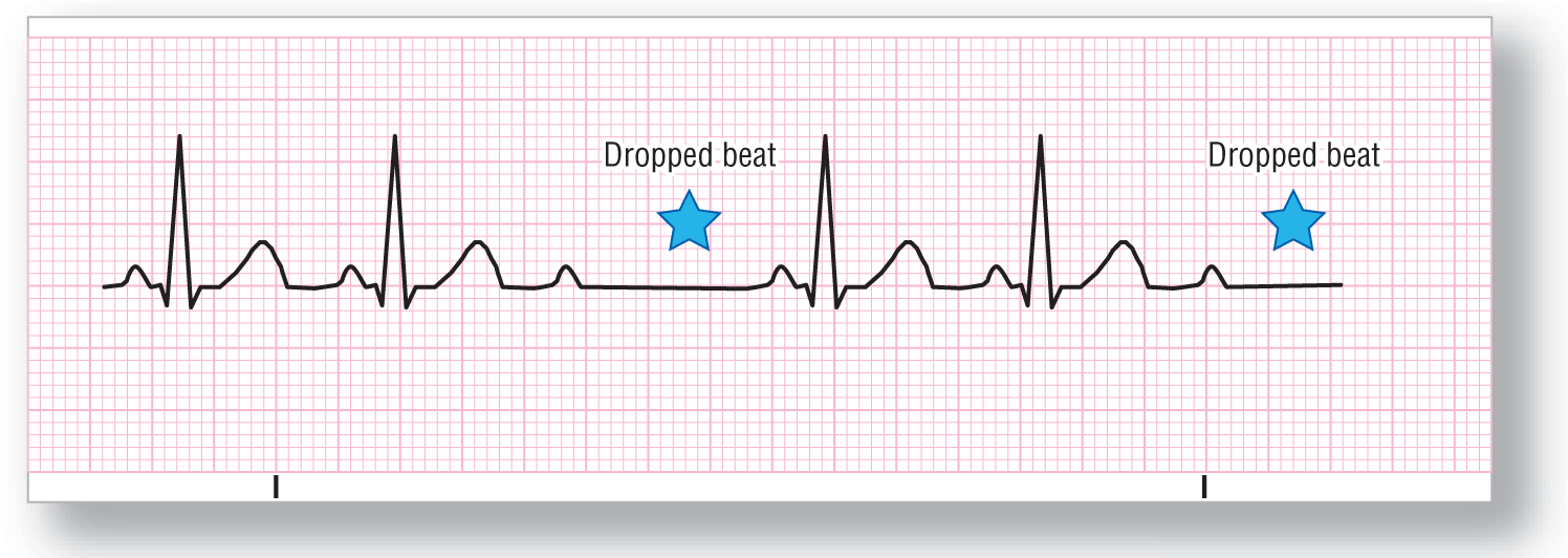 A rhythm strip for Mobitz 2 second-degree heart block shows a dropped beat occurring at every third ECG complex, corresponding a missing QRS complex.