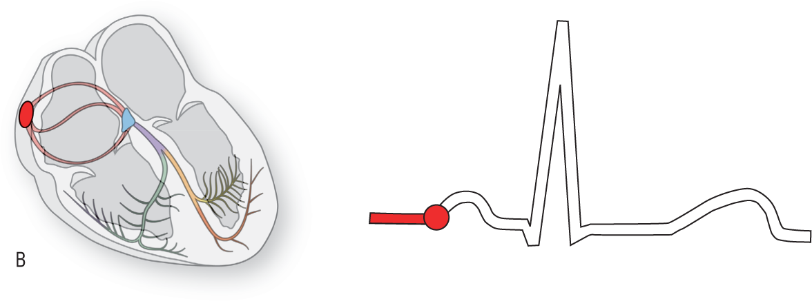 An illustration shows the conduction system of the heart, with the SA node highlighted. An ECG shows the pointer at the beginning of the P wave.