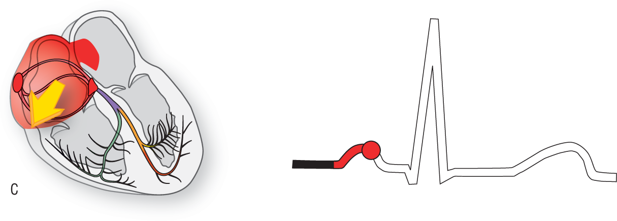 An illustration of the conduction system of the heart and an ECG show the condition when the right atrium depolarizes.