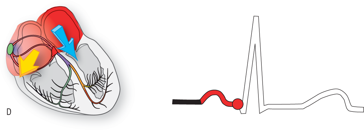 An illustration of the conduction system of the heart and an ECG show the condition when the left atrium depolarizes.