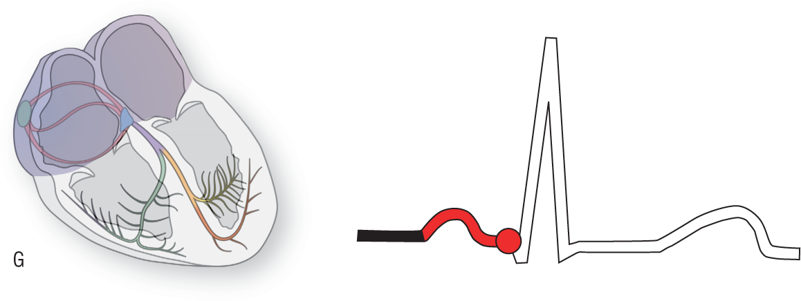 An illustration of the conduction system of the heart shows the atria highlighted. An ECG shows the pointer at the end of the PR interval.