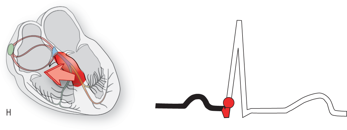 An illustration of the conduction system of the heart and an ECG show the condition when the upper septal area of the ventricles start to depolarize.