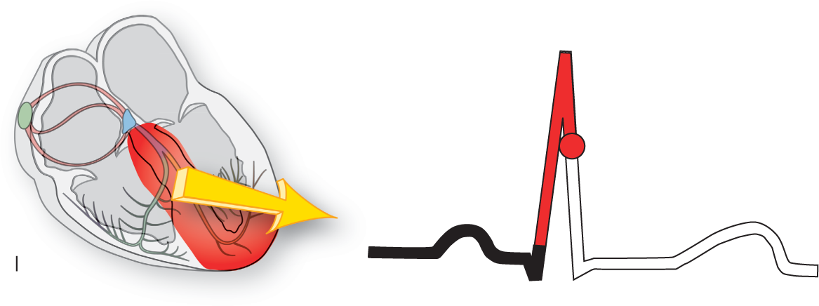 An illustration of the conduction system of the heart and an ECG show the condition when a major portion of the left ventricle depolarizes.