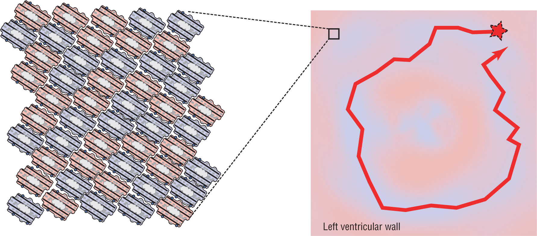 An illustration shows the irregular circular path of an impulse in the left ventricular wall. A magnified view of the portion of the wall shows a matrix of cells, highlighted in pink and gray.