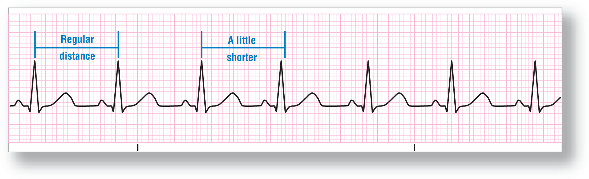 An ECG strip shows that in a normal sinus rhythm, the fourth complex occurs a little earlier than the rest in the sequence.