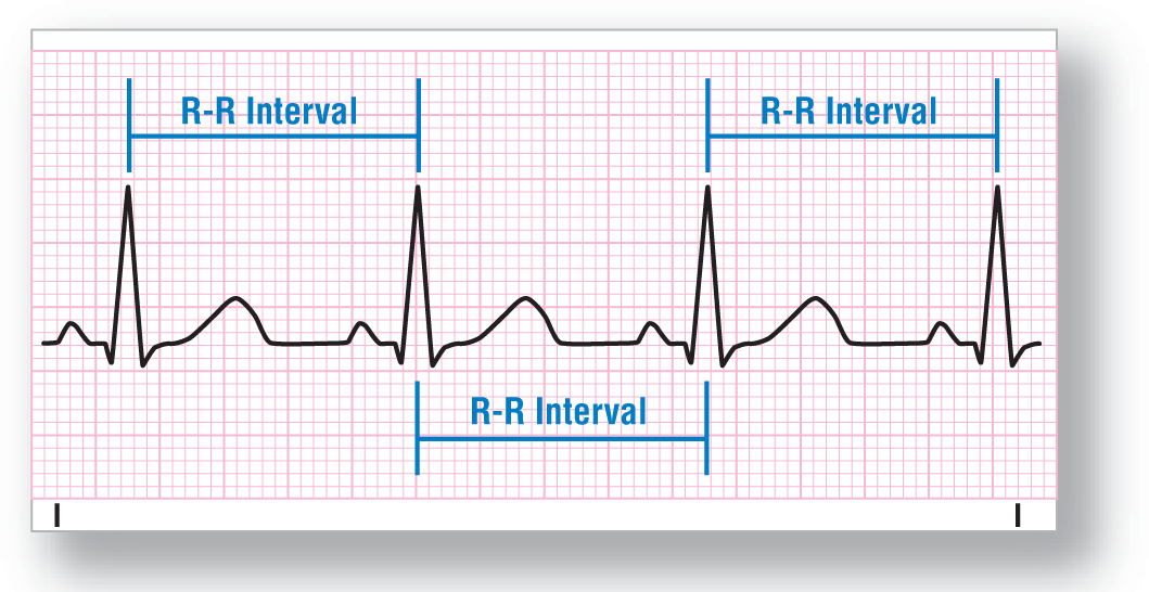 An ECG strip shows a normal sinus rhythm. R-R intervals are measured between the peaks of consecutive R waves.