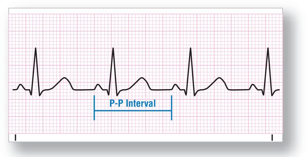 An ECG strip shows a normal sinus rhythm. P-P intervalis measured between the beginning of consecutive P waves.