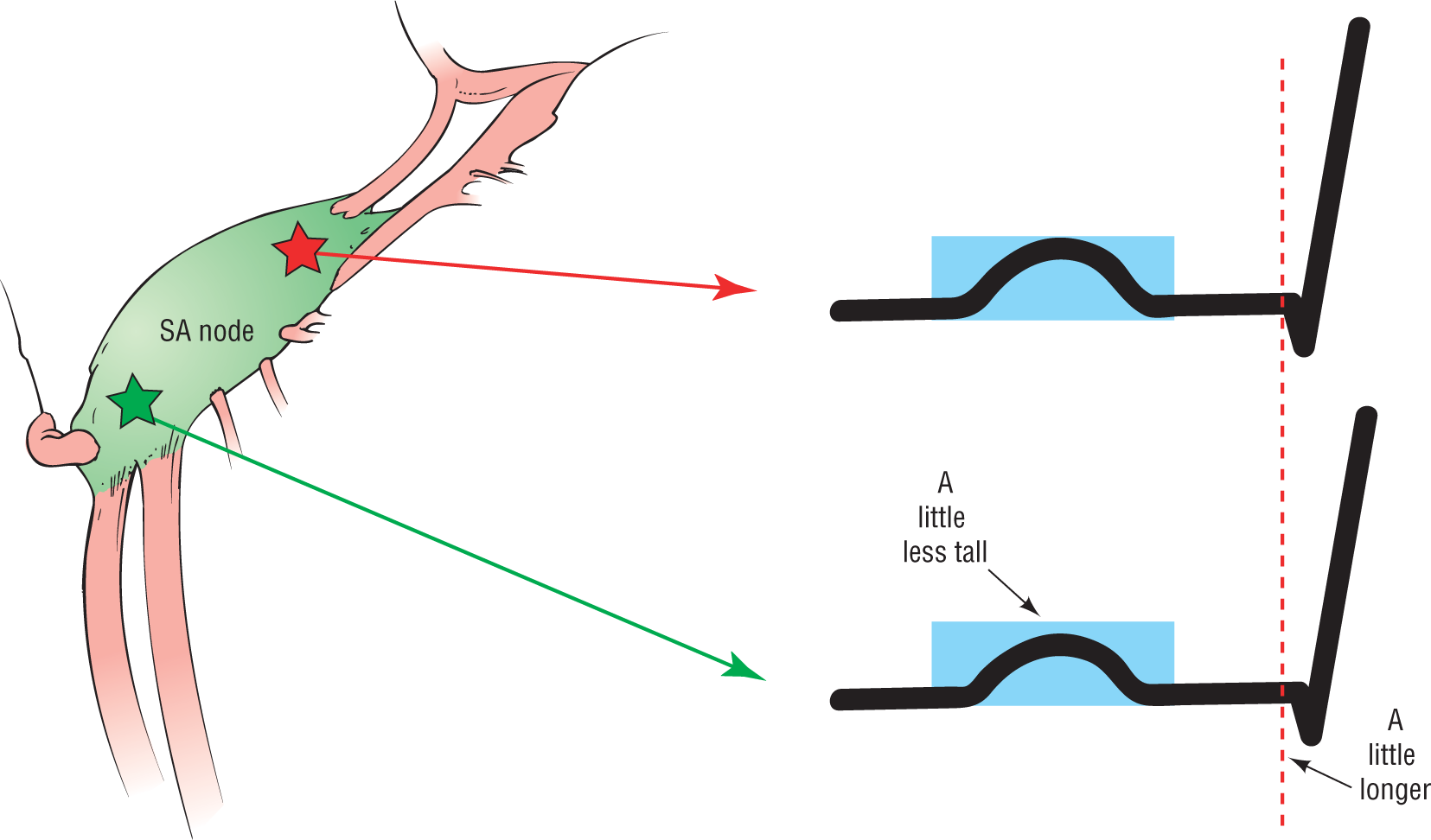 An illustration shows that the height of the P wave differs when the waves originate from different points in the SA node.