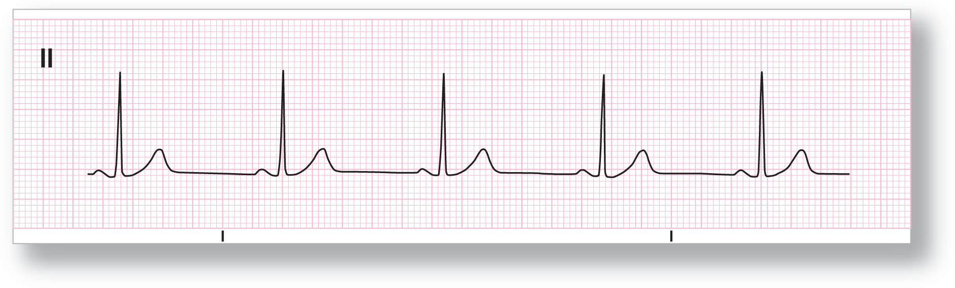 A rhythm strip from lead 2 shows a subtle, curved peak of the P wave, a tall and sharp peak of the QRS complex, and a short and curved peak of the T wave. The TP intervals are long and flat.