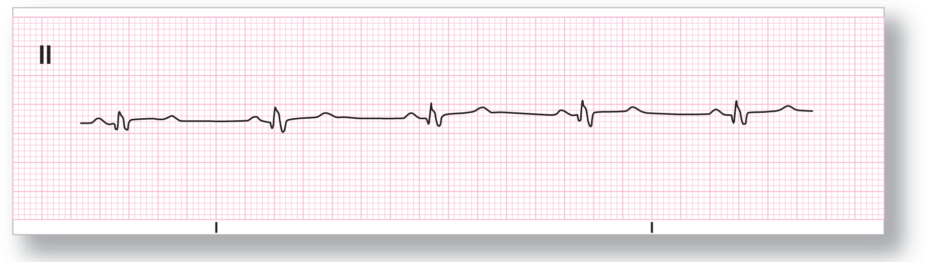 A rhythm strip from lead 2 shows a small and sharp peak of the QRS complex with subtle and curved peaks of the T and P waves on its either side. The TP intervals are long and flat.