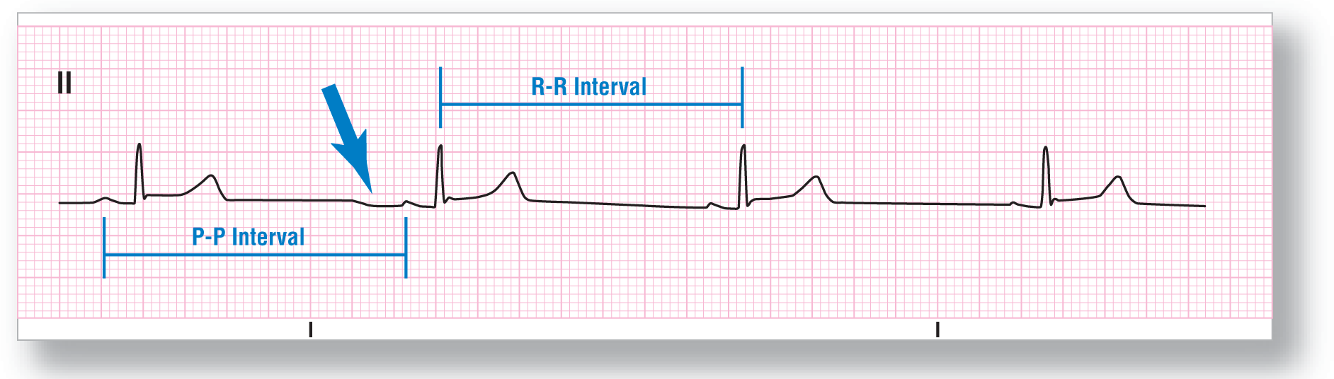 A rhythm strip from lead 2 shows a subtle, curved peak of the P wave, a tall and sharp peak of the QRS complex, and a short and curved peak of the T wave. The TP, P-P, and R-R intervals are long.