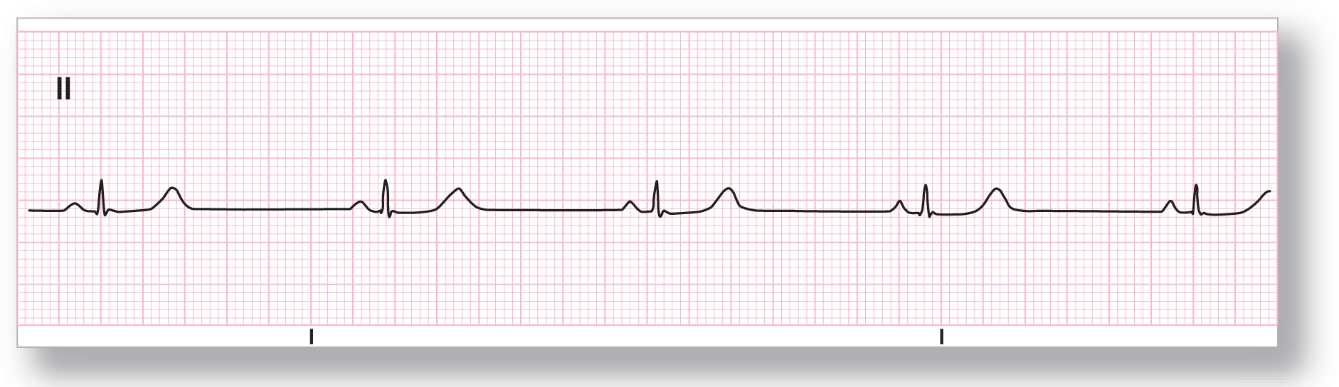 A rhythm strip from lead 2 shows a small and curved peak of the P wave, a sharp peak and a curved peak of the QRS complex and the T wave, both of same height. The TP intervals are long and flat.